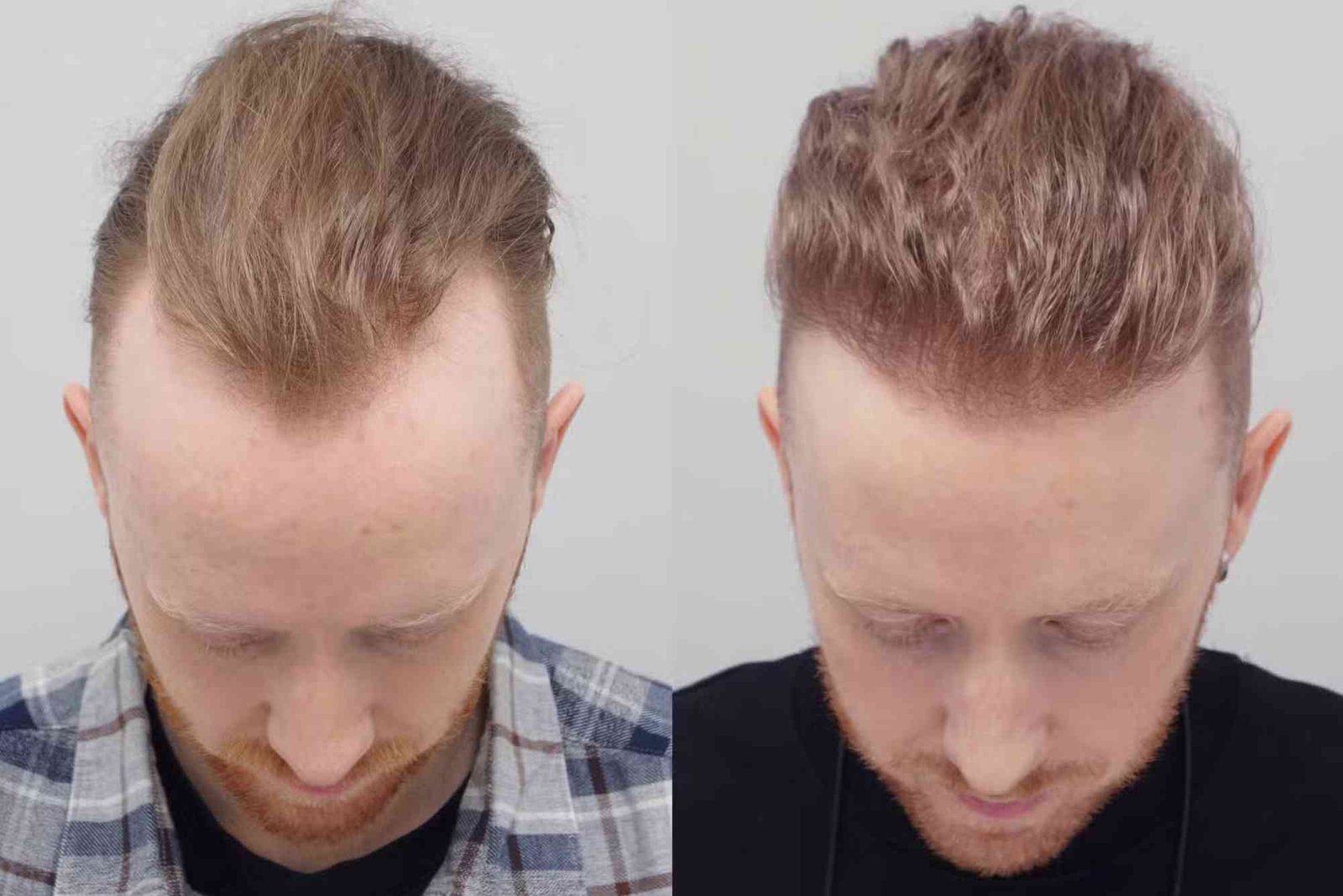 Best Hair Transplat Turkey